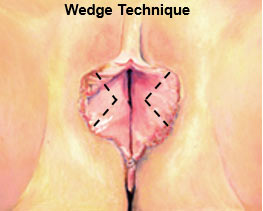 روش جراحی لابیاپلاستی- عمل زیبایی واژن